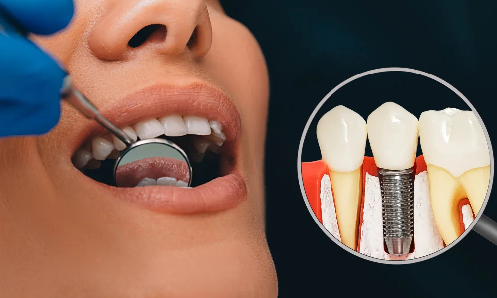 dental implants 